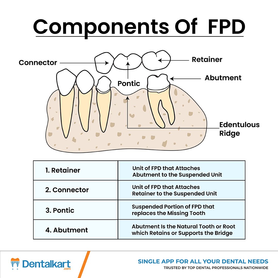 Dentalkart's tweet image. Key Parts of FPD Bridge

-Retainer attaches the bridge to supporting teeth for stability.
-Pontic replaces the missing tooth in the edentulous area.
-Connectors link each unit, while abutments provide crucial support.

#DentalBridge #FPD #Prosthodontics #OralRehab #HealthyTeeth