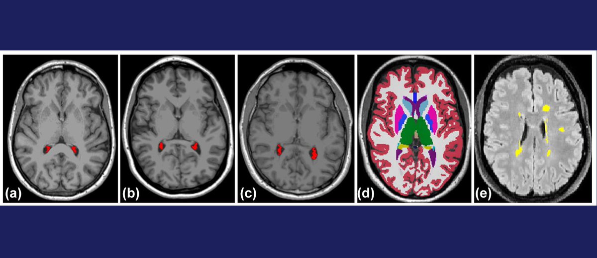 radiologyto's tweet image. This study authored by Dr. Suradech Suthiphosuwan from @radiologyto investigates whether people with Radiologically Isolated Syndrome have changes in a specific brain structure called the choroid plexus.
Link to article: rpb.li/H7YMy
@UofTMedIm @UnityHealthTO