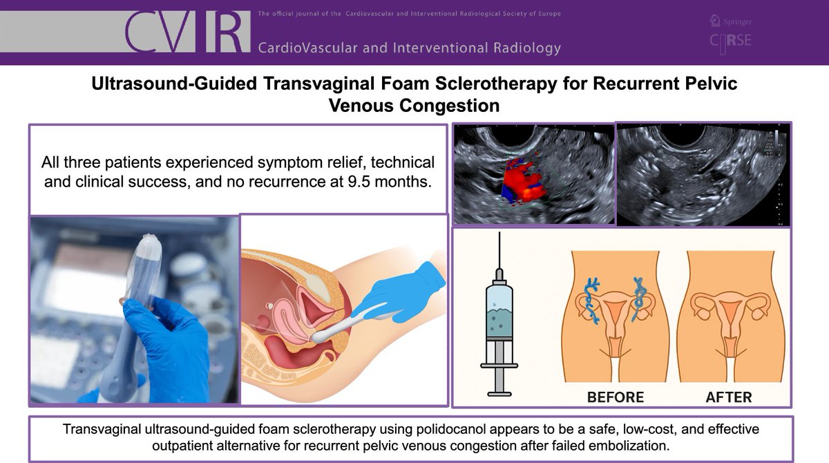 CVIR_Journal's tweet image. #LettertoEditor 📬
Ultrasound-Guided Transvaginal Foam Sclerotherapy for Recurrent Pelvic Venous Congestion: A Low-Cost Outpatient Alternative
link.springer.com/article/10.100…