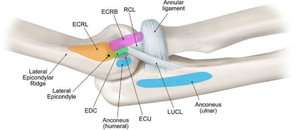 Omid_HopeUni's tweet image. Lateral elbow anatomical attachments:

&amp;gt;ECRB/extensor carpi radialis brevis
&amp;gt;ECRL/extensor carpi radialis longus
&amp;gt;ECU/extensor carpi ulnaris
&amp;gt;EDC/extensor digitorum communis
&amp;gt;LUCL/lateral ulnar collateral ligament
&amp;gt;RCL/radial collateral ligament

#elbow

journals.sagepub.com/doi/10.1177/23…