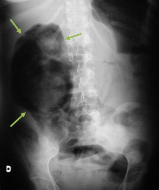 This diabetic patient presented with fever, right flank pain, nausea, and vomiting. 

Likely diagnosis?