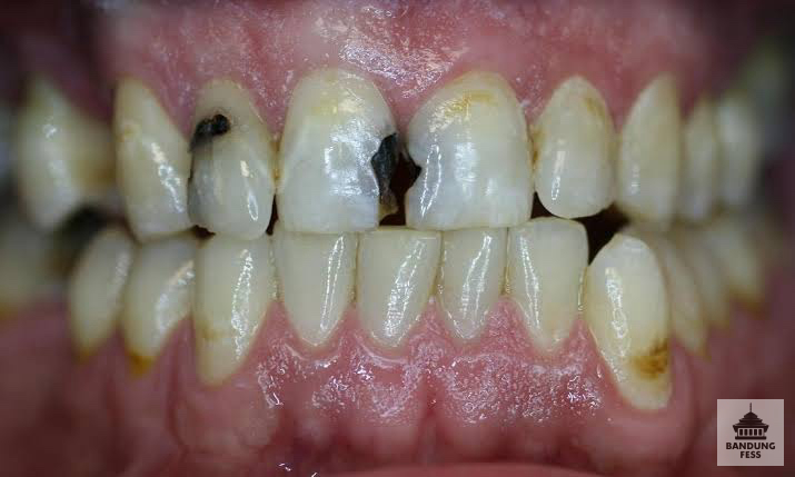 BaseBDG's tweet image. 💛 adakah yg gigi depannya berlubang besar seperti digambar atau lebih parah, pernah sakit, dan mau dirawat koas untuk perawatan saluran akar terus ditambal permanen? syaratnya mau ke rsgm unpad bandung sampai perawatannya selesaii

kalau mau, reply yaa nanti aku hubungi