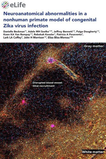 "Studien deuten darauf hin, dass COVID-19 in der Schwangerschaft die fötale Gehirnentwicklung am ehesten über.. Immunaktivierung beeinträchtigt. 

..eine Kinder Generation.., die mit #LongCovid geboren werden, &amp; die meisten.. werden erst Jahre / Jahrzehnte später bemerkt werden"