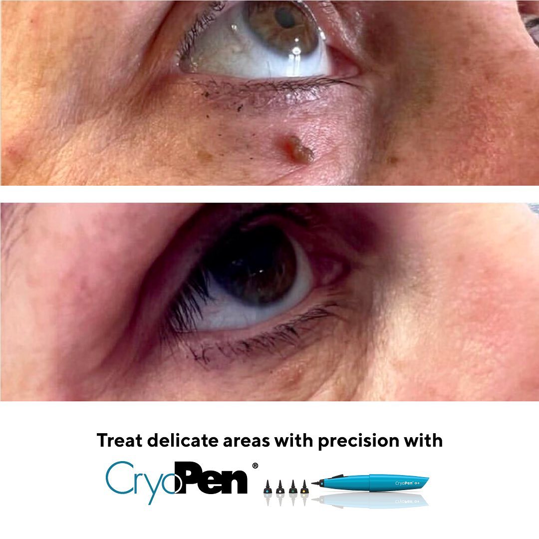 DrVineetaA55454's tweet image. Achieve flawless skin around the eyes with CryoPen's precise treatment! ✨❄️🎯 Remove skin lesions quickly and effectively. Book your consultation now! #CryoPen #SkinLesions #EyeArea #PrecisionTreatment #SkinCare #Beauty
