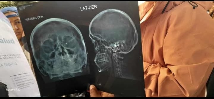 RedKapari's tweet photo. #ATENCIÓN
#SOLIDARIDAD con José Isidro Chávez Chávez victima de la brutal represión. 

José Isidro Chávez Chávez, comunero de Cercado – Cotacachi, resultó gravemente herido durante los recientes hechos de represión. Un perdigón impactó su ojo izquierdo, y su estado es crítico. Los médicos han indicado que requiere una cirugía urgente, valorada entre $3.500 y $4.000🙏, una cantidad que su familia — no puede — cubrir sola.

🤝 Por ello, se hace un llamado solidario a todas las personas y comunidades que deseen apoyar a #José en este momento tan difícil. Cada aporte cuenta, y puede marcar la diferencia para salvar su vista y su vida.

📍 Cuenta Banco Pichincha
💳 Cuenta de ahorros: 2206886161
👤 Titular: José Luis Chávez Chávez
📞 Contacto: 099 969 8540 (José Luis Chavéz-hermano)

🙏🏽 Tu ayuda es esperanza.

@RedKapari
#PrimeraLinea #PARONACIONAL2025 #Diesel 
#Solidaridad #Cotacachi #Imbabura #SoloElPuebloSalvaAlPueblo #JusticiaYVida