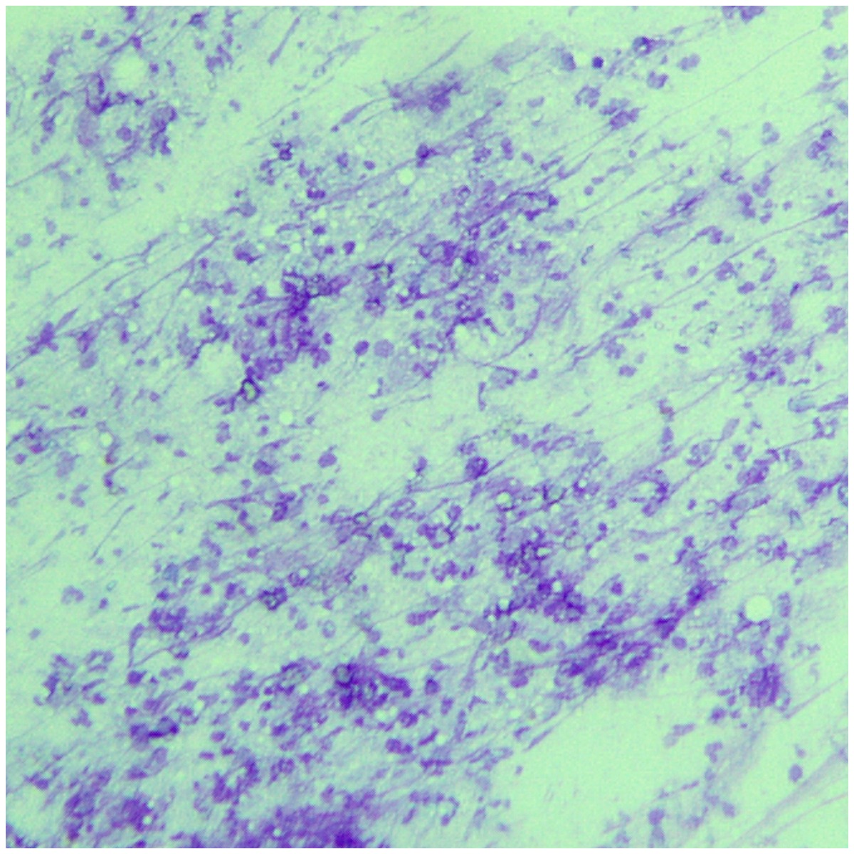 touilhisto's tweet photo. Lymph node FNA
Purulent adenitis
#cytopath
#FNA
#lymphnode
#pictwitter https://t.co/CcLDa8VQcd