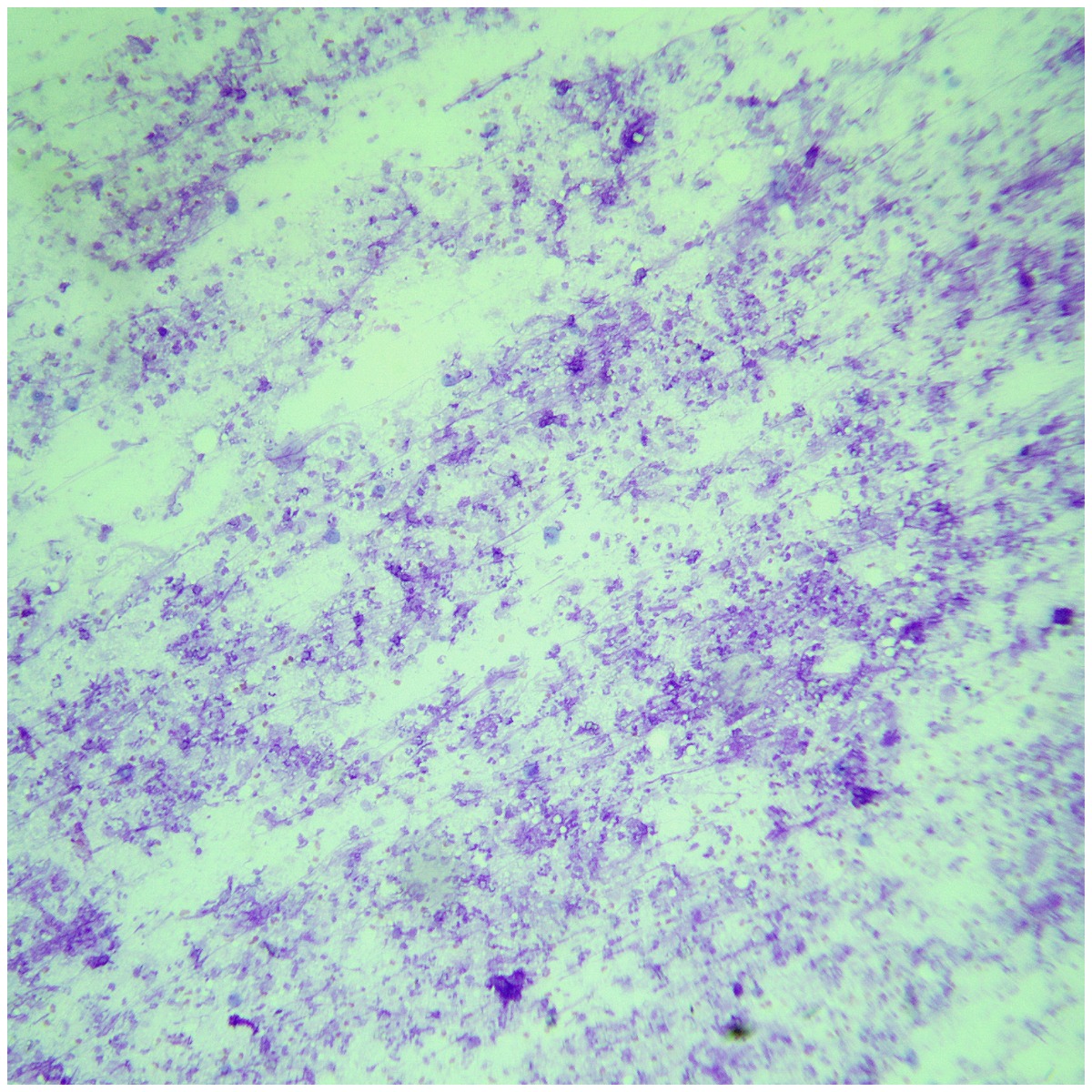 touilhisto's tweet photo. Lymph node FNA
Purulent adenitis
#cytopath
#FNA
#lymphnode
#pictwitter https://t.co/CcLDa8VQcd