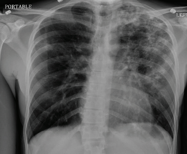 A rare case of Scedosporium infection in an immunocompetent patient.

This report highlights why unusual fungal pathogens should be considered even in healthy hosts presenting with cavitary pneumonia.

Bilateral multilobar cavitary pneumonia in an immunocompetent host

🔗