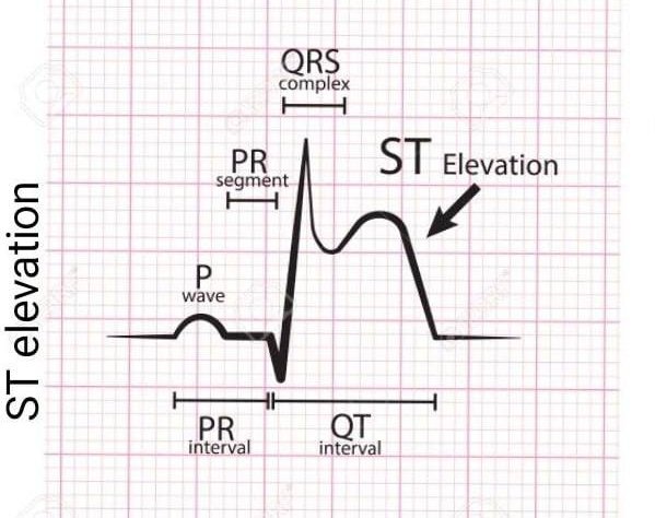 This ECG abnormality Keep Cardiologists and other hospital Doctors clashing all day and all night. All over the World. Until the patient is taken to the catheterization Lab.