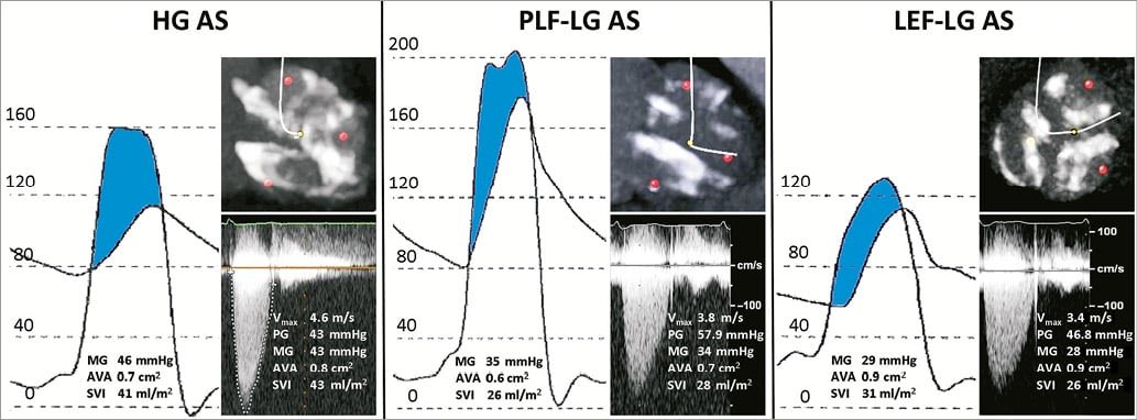 Assessment of low-flow, low-gradient, severe aortic stenosis:

cardiac catheterisation forms an integral part of the work-up of these patients in order to confirm or refute the echocardiographic findings to guide management decisions appropriately.

eurointervention.pcronline.com/article/assess….