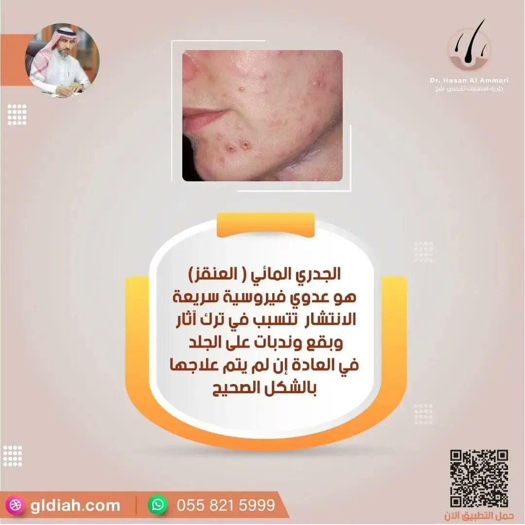 الجدري المائي ( العنقز ) هو عدوى فيروسية سريعة الانتشار تتسبب في ترك آثار وبقع وندبات دائمة على الجلد
 في العادة إن لم يتم علاجها بالشكل الصحيح.
.
. 
#جدري_مائي 
#جدري #جلدية
#السعودية
