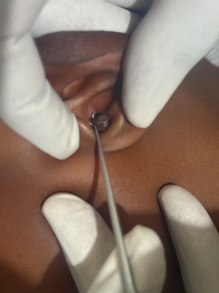 kenasaayele's tweet photo. Foreign body in the peadtric ear
#visitoromia #Ethiopia https://t.co/87Ss7xz1P0