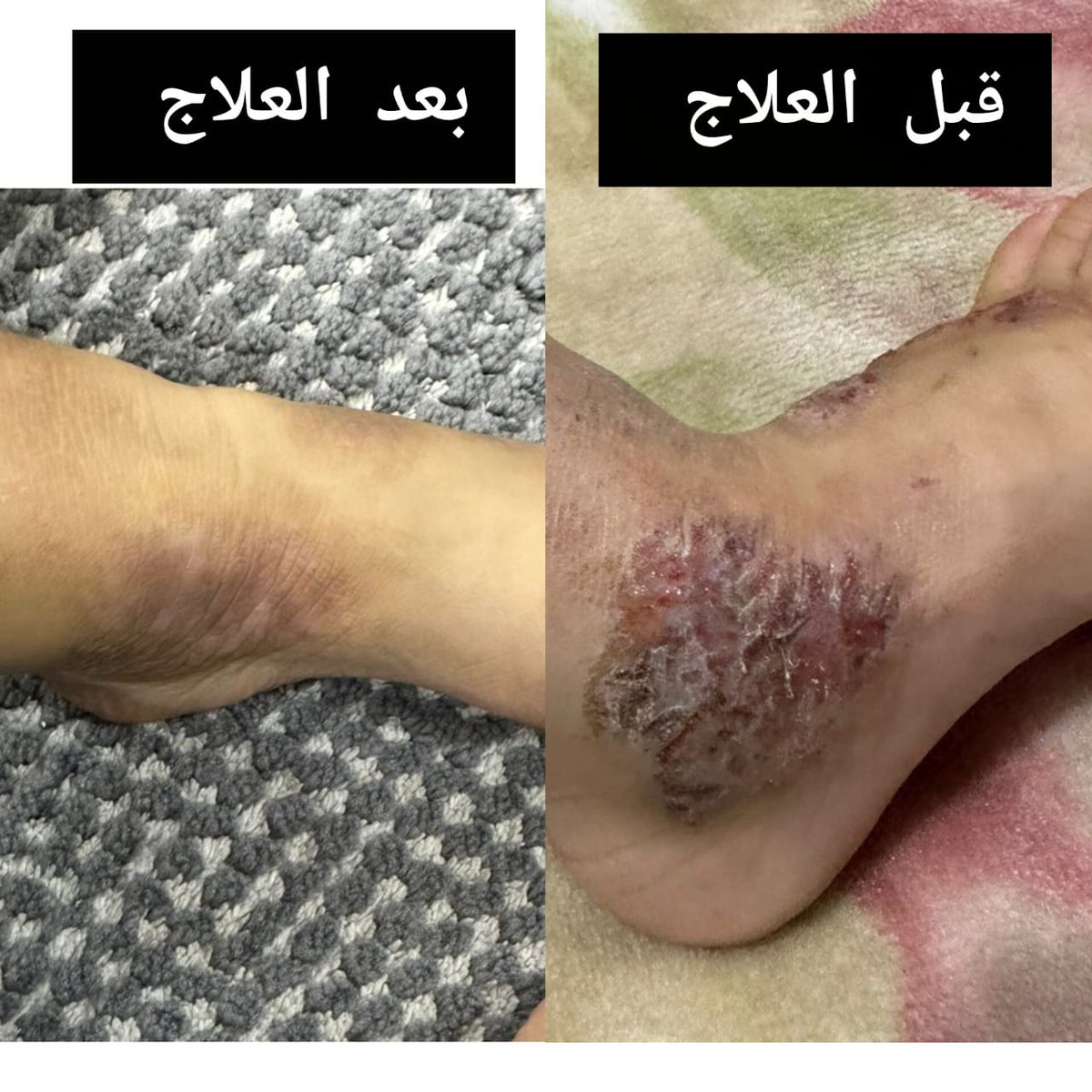 قبل وبعد العلاج 👌
تحت إشراف الدكتور حسن العماري استشاري طب الأسرة والأمراض الجلدية 🌹
.
 
.

#مشكلات_جلدية 
#أمراض_جلدية
#اكزيما #اكزيما_جلدية
#السعوديه_العراق