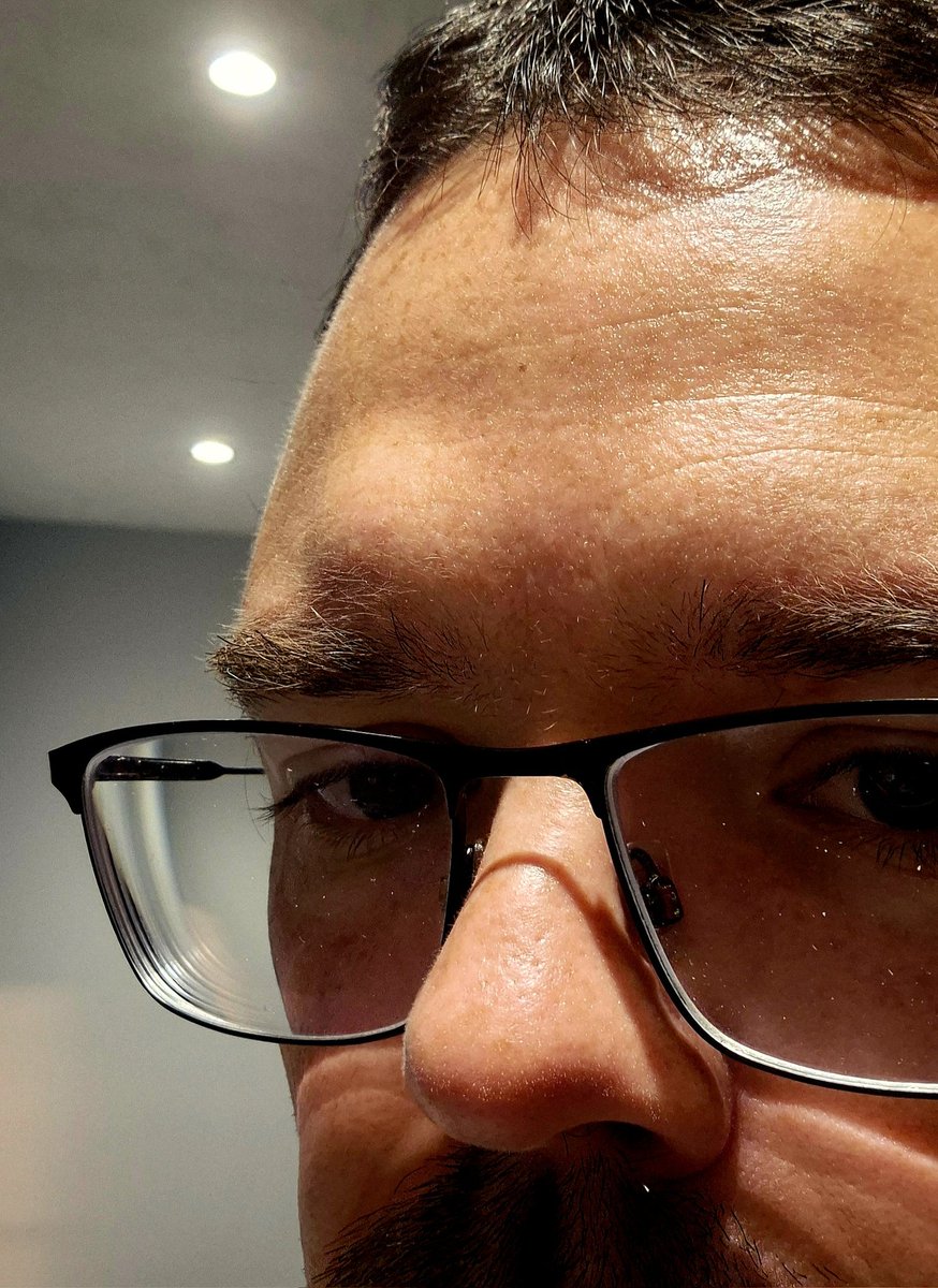 TheSixMachine's tweet image. Turns out your parents hard kitchen countertop isn&apos;t the best place for your head to land after you pass out 😅, ngl I thought the bump would be bigger but still, ouch 🤣