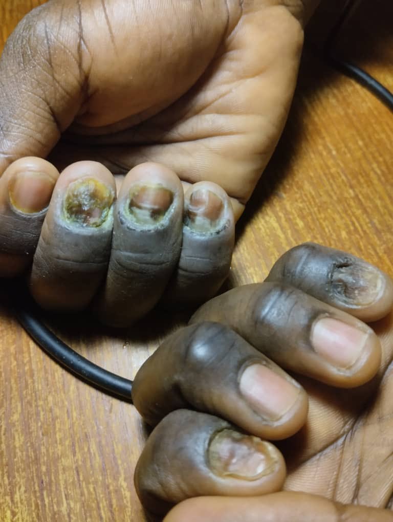 safonyameherbal's tweet photo. For NAIL INFECTION, Apply the latex of Thevetia peruviana (yoruba= Olomi-Ojo ) on the affected nails twice daily and be free from onychomycosis🍀.

You are going to have your beautiful nails back after this💚 https://t.co/xzSpfo2bsK