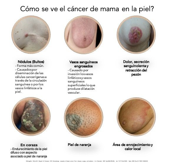 VCuyer's tweet photo. pd: Les dejo la imagen del cancer, por que no por que evitemos mostrarlo dejará de existir. Luchemos con más fuerza, voluntar y RECURSOS para cambiar la historia. https://t.co/NdxXnzadQf