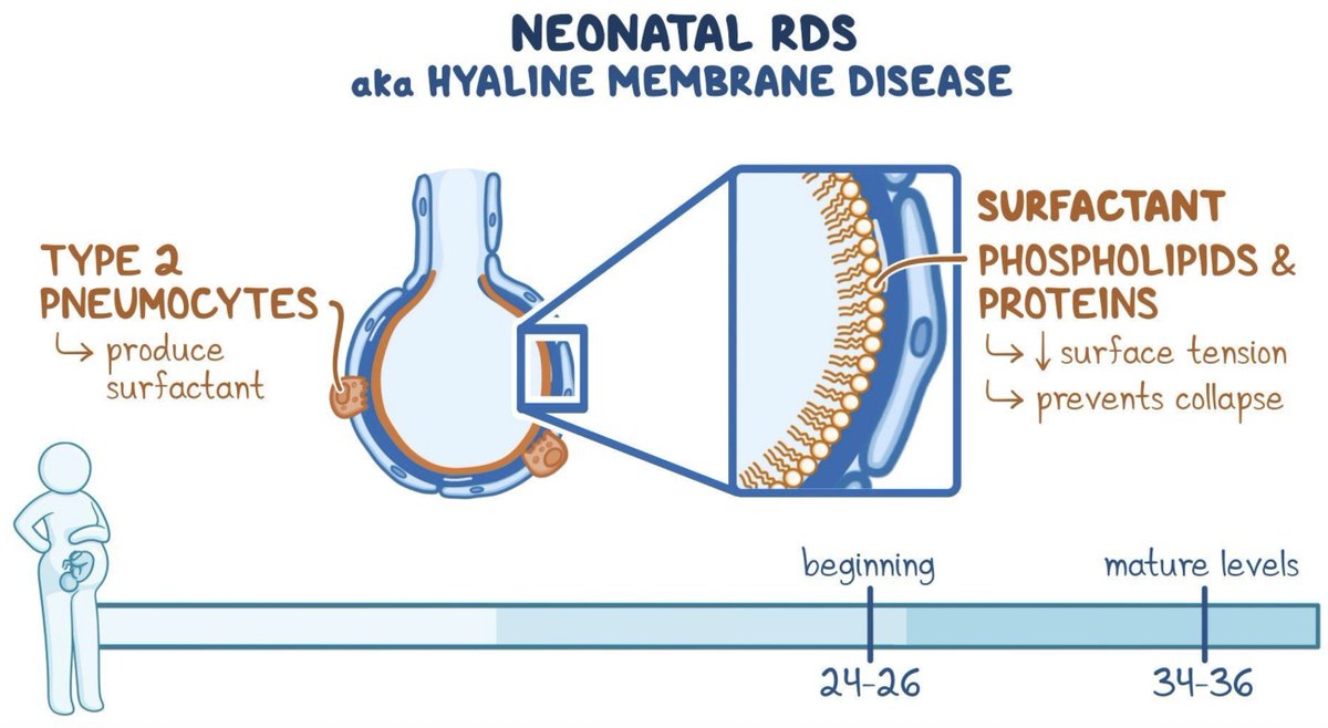 USMLEStepStudy's tweet image. Hyaline Membrane Dz (Neonatal RDS) - ↓Surfactant; MCC: prematurity, Maternal DM (fetal hyperinsulinemia ↓ surfactant), c-section w/out labor; s/s: postnatal resp distress, grunting, nasal flaring, retractions, tachypnea, cyanosis