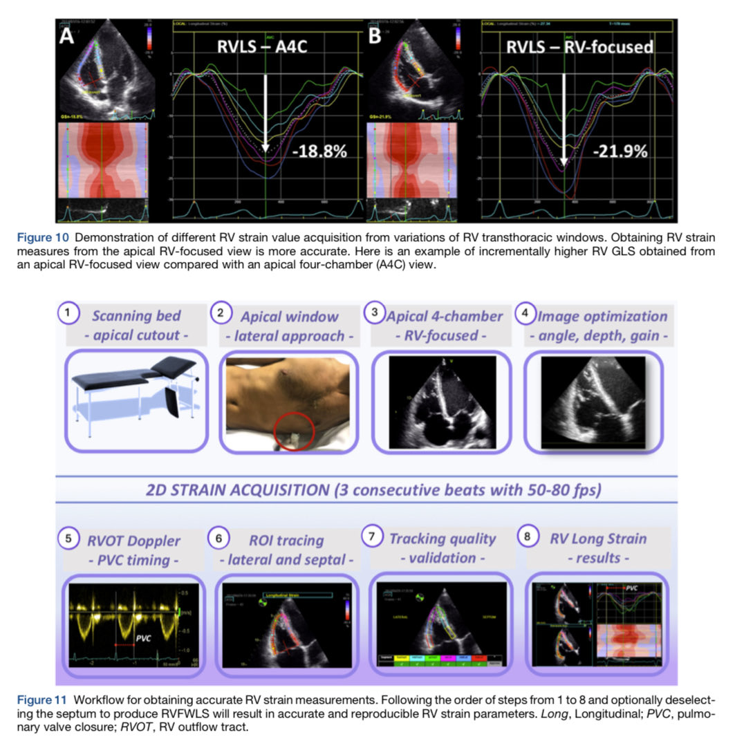 🔴 Clinical Applications of Strain Echocardiography: A Clinical Consensus Statement From <a href="/ASE360/">American Society of Echocardiography</a> #Cardiology #CardioEd #Echofirst #Strain