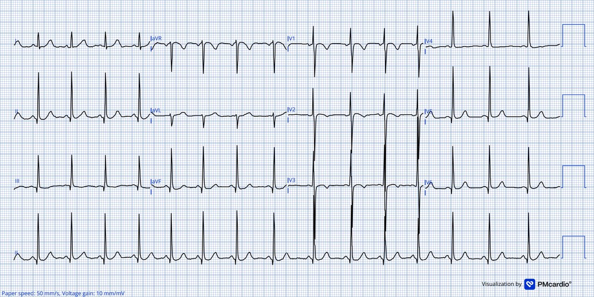 TheECGMedic's tweet image. What do you think of this? 

#ECG #ECGChallenge
