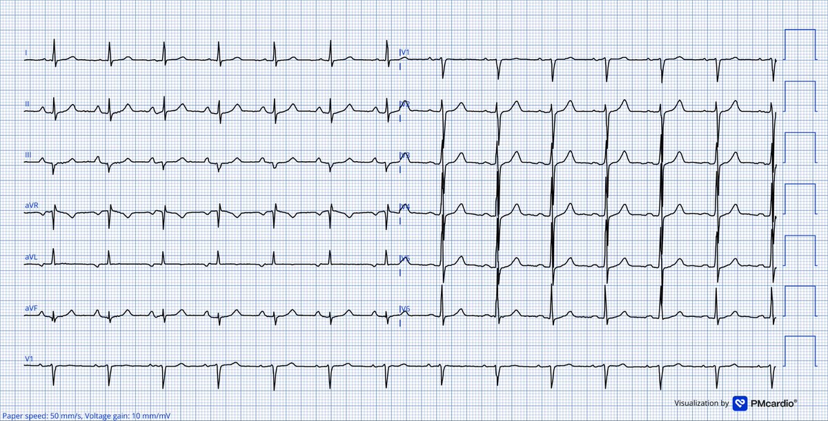 TheECGMedic's tweet image. This patient is complaining of intermittent chest pain. 

Does anything concern you here?

#ECG #ECGChallenge