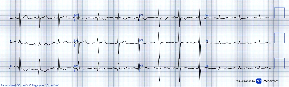 TheECGMedic's tweet image. What conditions may be associated with these ECG findings?

#ECG #ECGChallenge