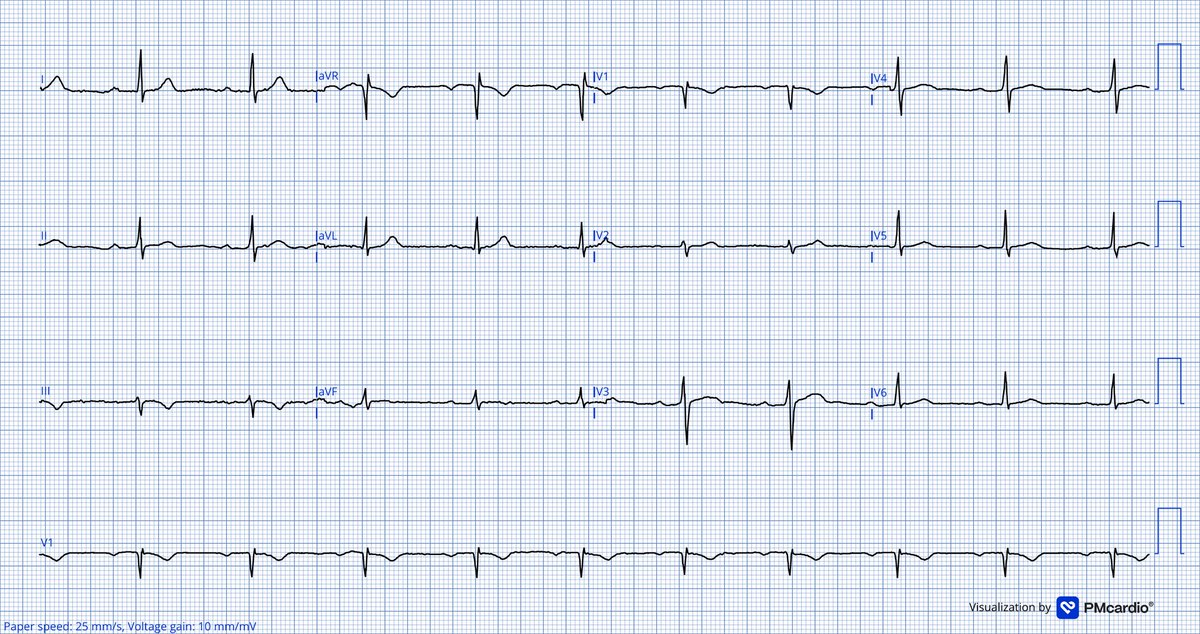 TheECGMedic's tweet image. 50M with CP relieved on use of own GTN spray. Is this ECG ischaemic?

#ECG #ECGChallenge