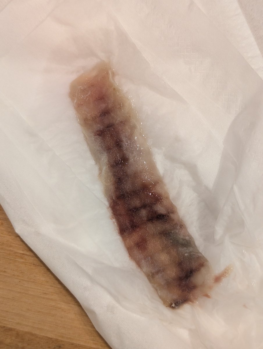 実は先日鼻の手術をして、ここ最近は鼻の奥にずっと詰め物がある状態且つ鼻の穴の表面に綿球を詰めたままで生活しているのですが、片方の鼻の奥の詰め物が取れてしまって片方だけ鼻がめっちゃ通るようになったけど匂いがわからなくなってしまいました。大丈夫かこれ？

※グロ画像注意