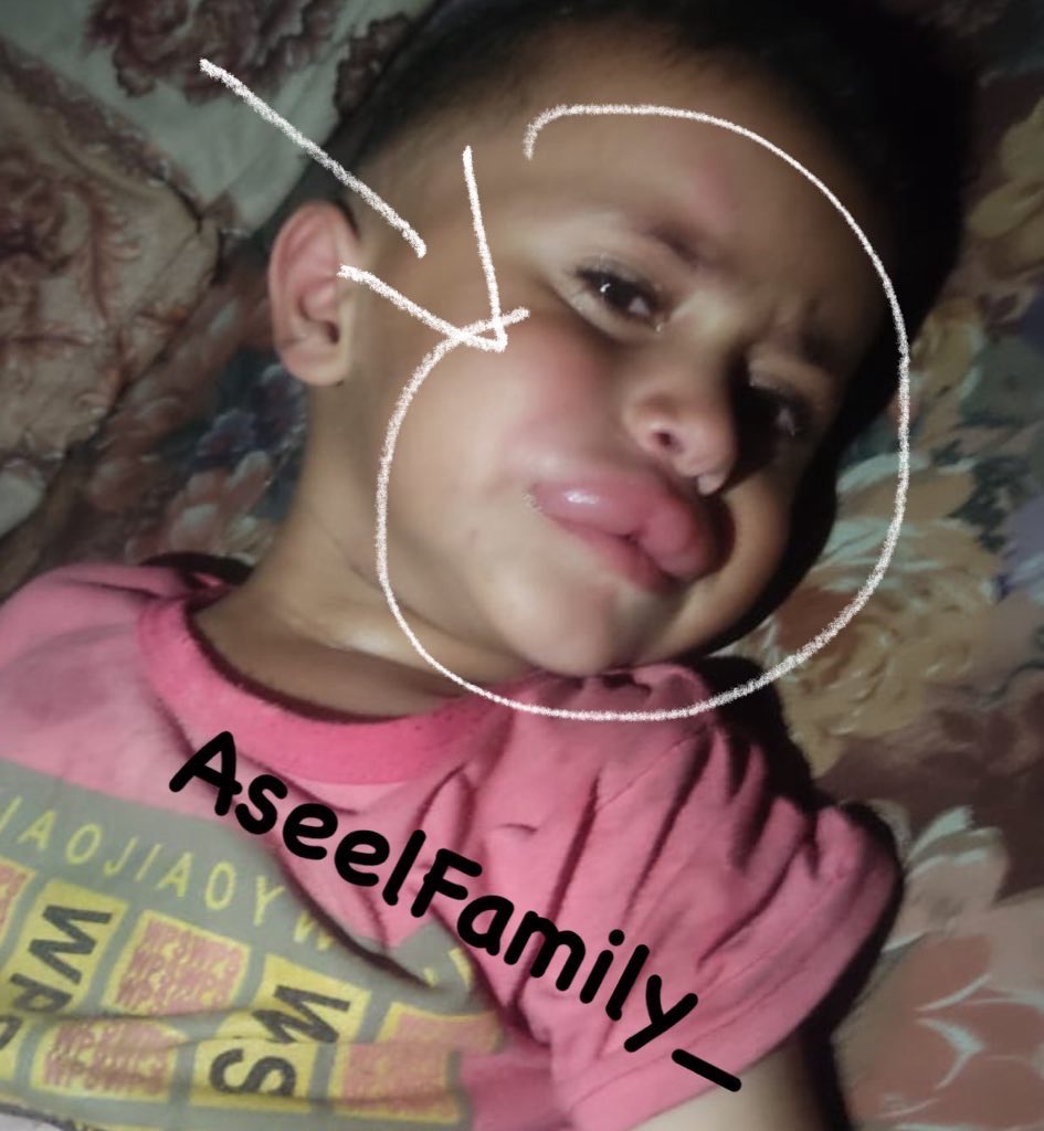STOP STOP. 💔💔

The Rodents are biting my little son face 💔

causing swelling, burning, and the swelling spreading all over his body. I am afraid that the disease will worsen. He needs urgent treatment.

If you’re scrolling, PLEASE leave a dot . 💔

chuffed.org/project/aseel