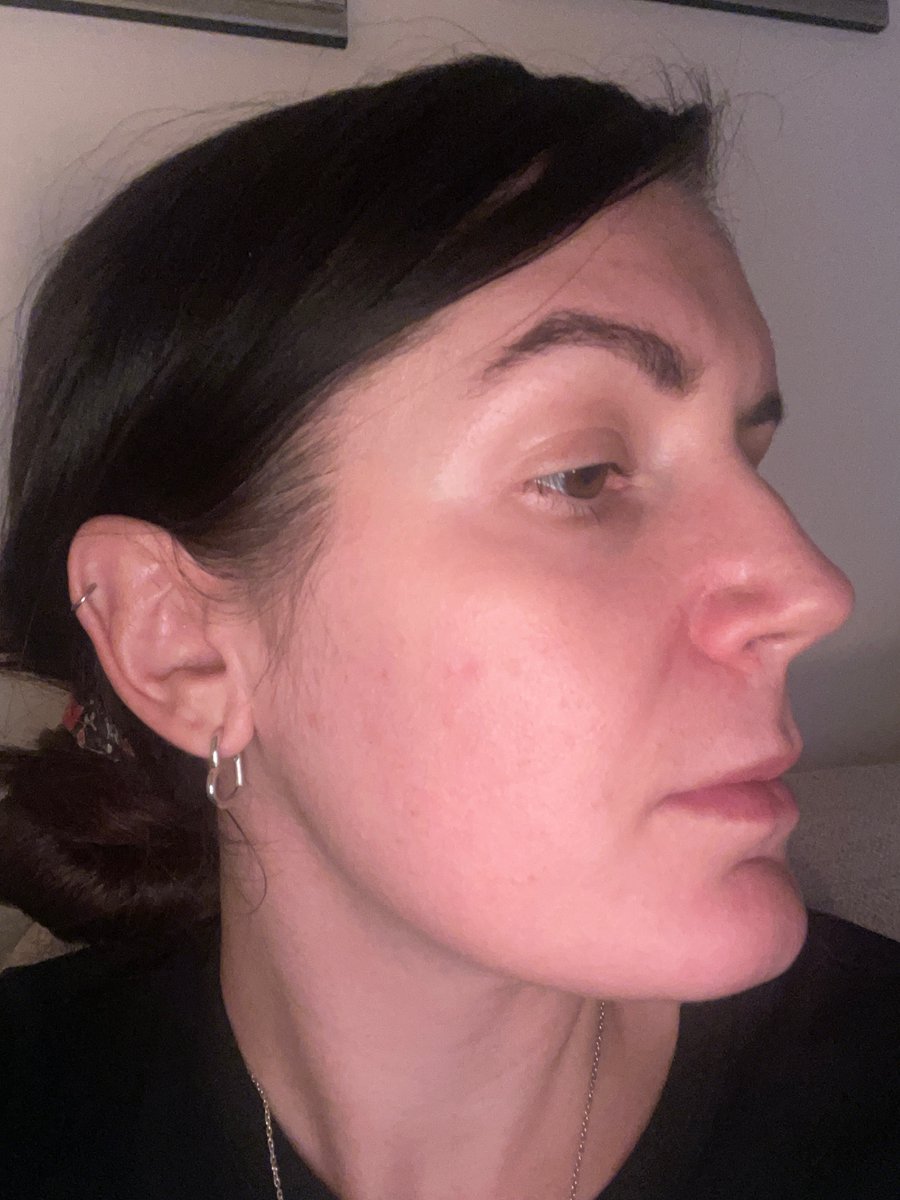 🗣Name: Gemma
❤️Skin concern: Melasma
⏰Treatment length: 5 months