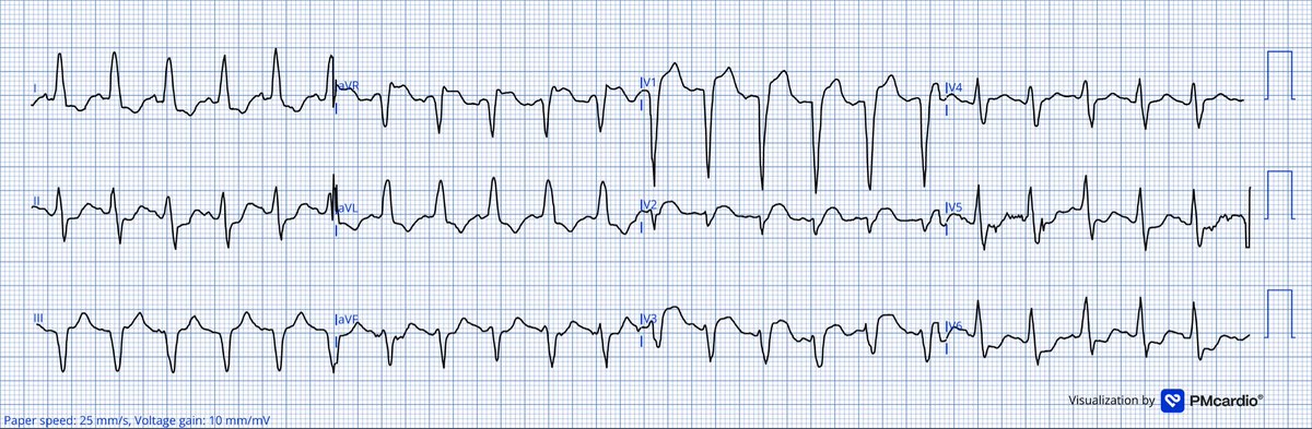 TheECGMedic's tweet image. Middle aged patient arrives to the ED in acute heart failure. This is the paramedics ECG. 

What do you make of their ECG?

#ECG #ECGChallenge