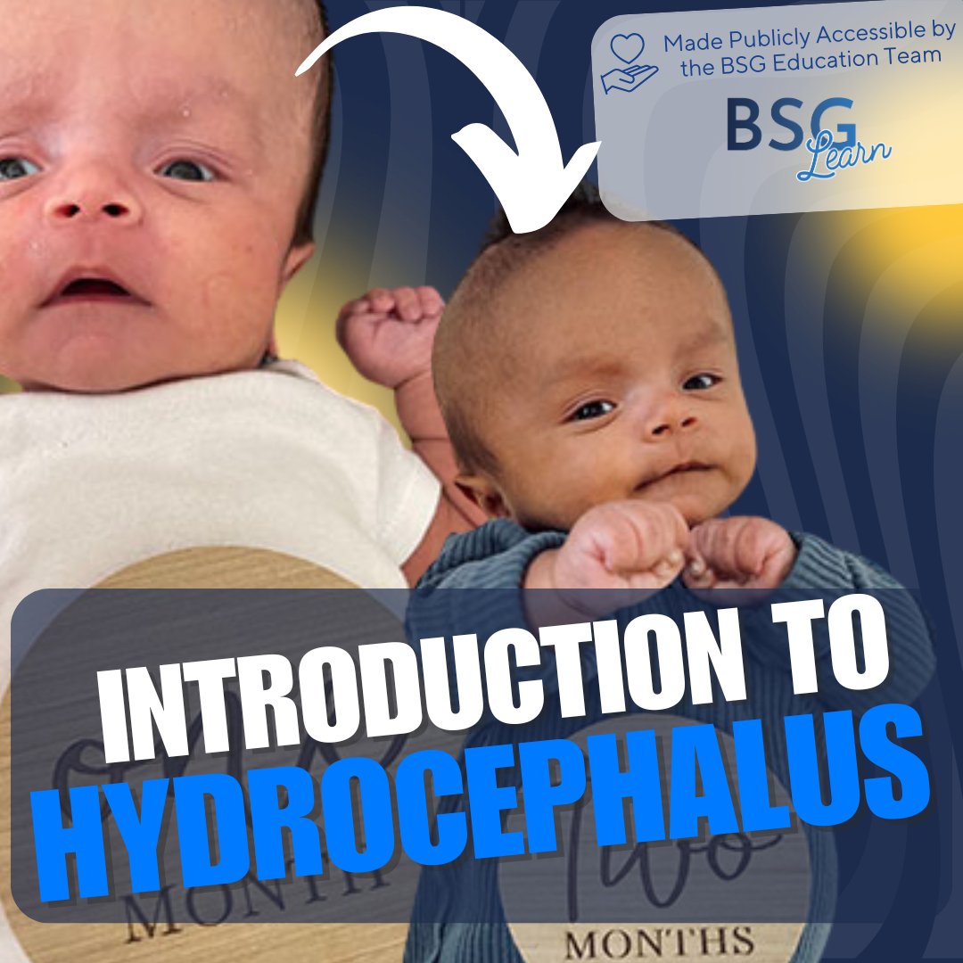 Brain & Spine Group (@brainspinegroup) on Twitter photo 🚨NEW SECTIONS NOW LIVE 🚨
💡 Learn about hydrocephalus in our new course on BSG Learn! Perfect for aspiring med students & curious minds.
👉 Enroll now: sbee.link/xq3dypnw7f
#Hydrocephalus #MedicalEducation #Neurosurgery #BSGLearn 🚨NEW SECTIONS NOW LIVE 🚨
💡 Learn about hydrocephalus in our new course on BSG Learn! Perfect for aspiring med students & curious minds.
👉 Enroll now: sbee.link/xq3dypnw7f
#Hydrocephalus #MedicalEducation #Neurosurgery #BSGLearn