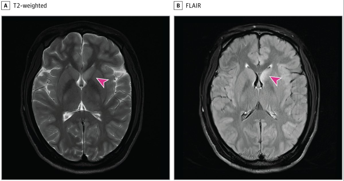 Hepatitis B in the brain.
What?
Yes!
The CSF was ✚
My only concern: Is the MRI finding seizure related or direct viral invasion ?
👻 times.