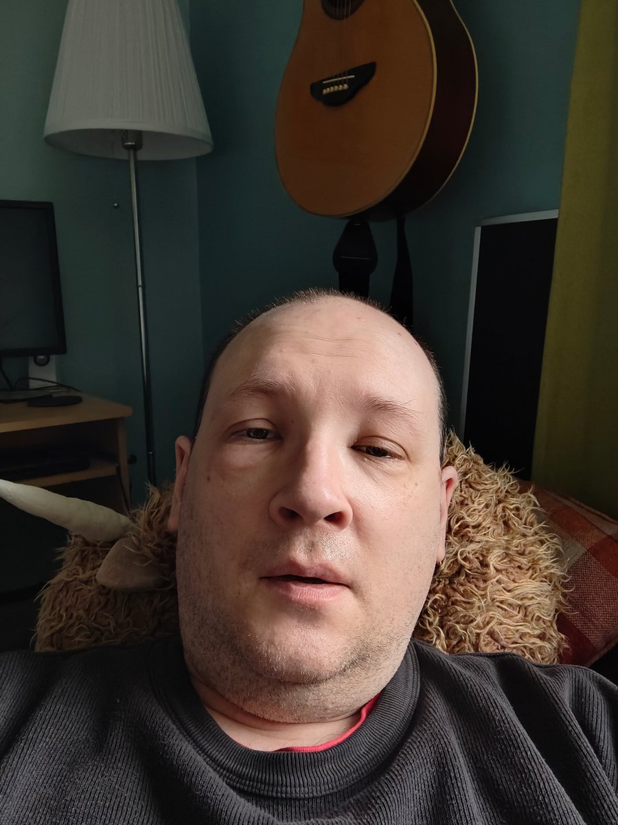 phunni's tweet photo. My daughter tells me I look rather like a wombat. There are far worse things... #joysofsinussurgery #youshouldseetheotherguy https://t.co/VZ9wDZ04rF