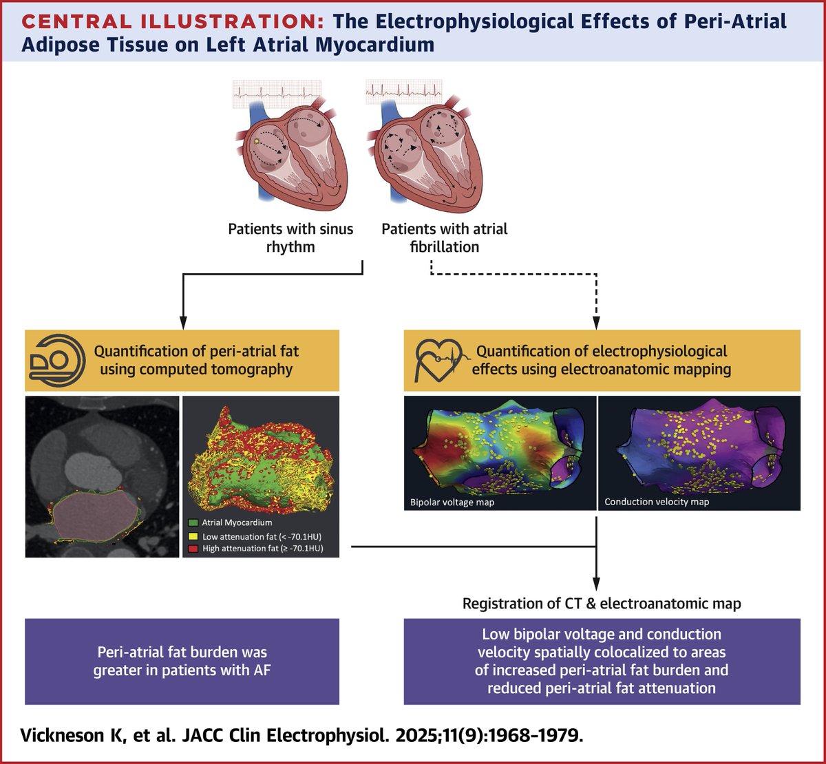 Peri-atrial adipose tissue volume was greater in patients with #AFib. Increased peri-atrial adipose tissue burden and reduced attenuation were spatially but weakly correlated with adverse electrophysiological remodeling in patients with AF. jacc.org/doi/10.1016/j.…