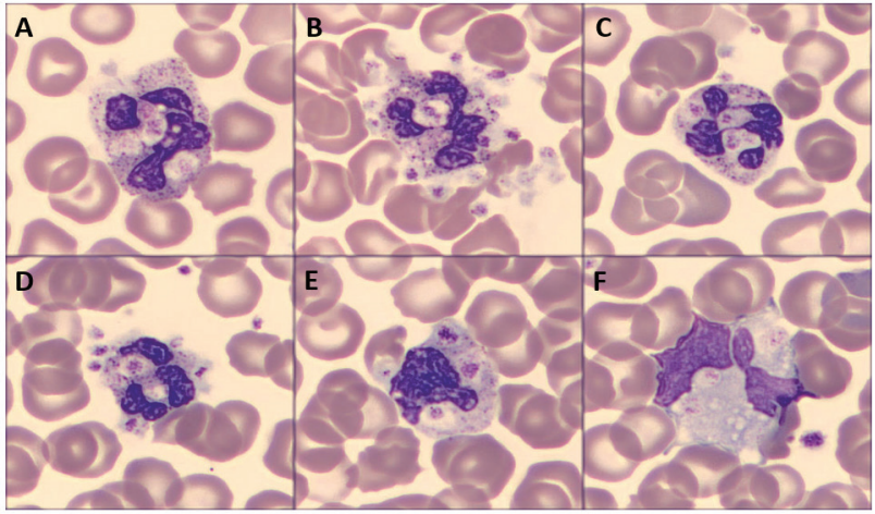 A rare case of thrombophagocytosis in a neonate without infection.

Delayed sample analysis caused falsely low platelet counts—risking misdiagnosis.

EDTA artifacts can deceive even the best analyzers.
Always trust your peripheral smear.

🔗ejmcr.com/articles/10.24…

#Pathology