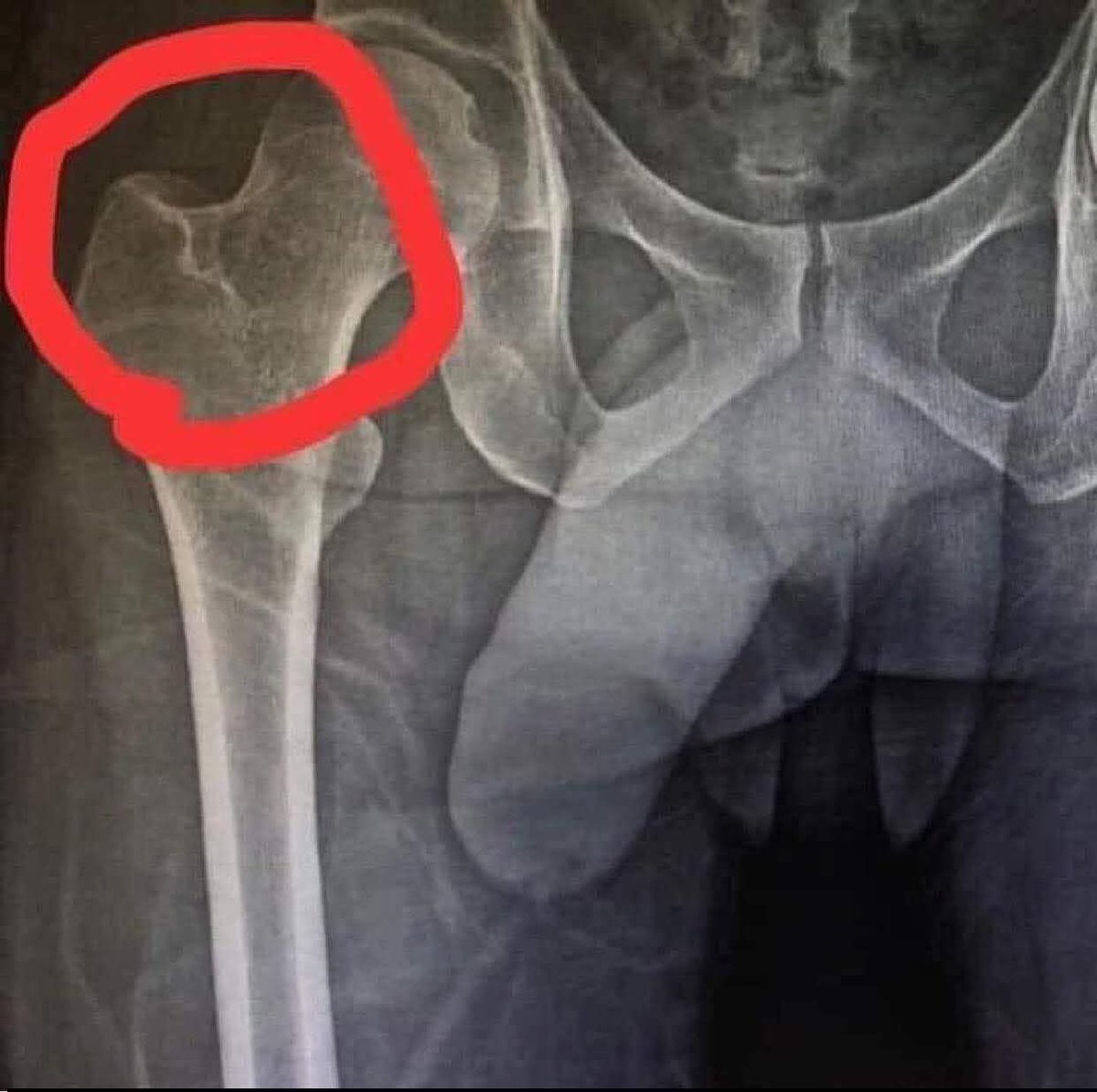 Tourus_Massage's tweet photo. Saya tertanya-tanya mengapa ia sakit apabila saya duduk dan berdiri, jadi saya pergi ke hospital dan menjalani X-ray. Baru tahu sebab... Rupanya tulang patah di paha kanan patut lah jalan sakit-sakit 😁😁😁😁 https://t.co/avaX9VQ1id
