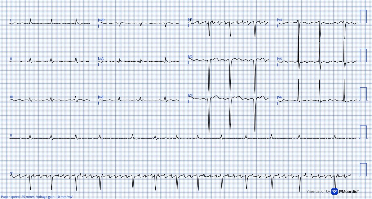 TheECGMedic's tweet image. What’s the rhythm here?

#ECG #ECGChallenge