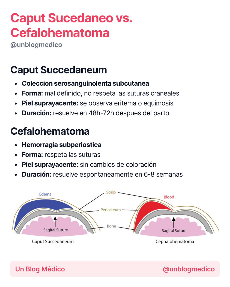 unblogmedico's tweet photo. 🏥 | Caput sucedaneo vs. Cefalohematoma:

Más resúmenes en: https://t.co/tZhGtuSd2H https://t.co/6r7i57JFz4