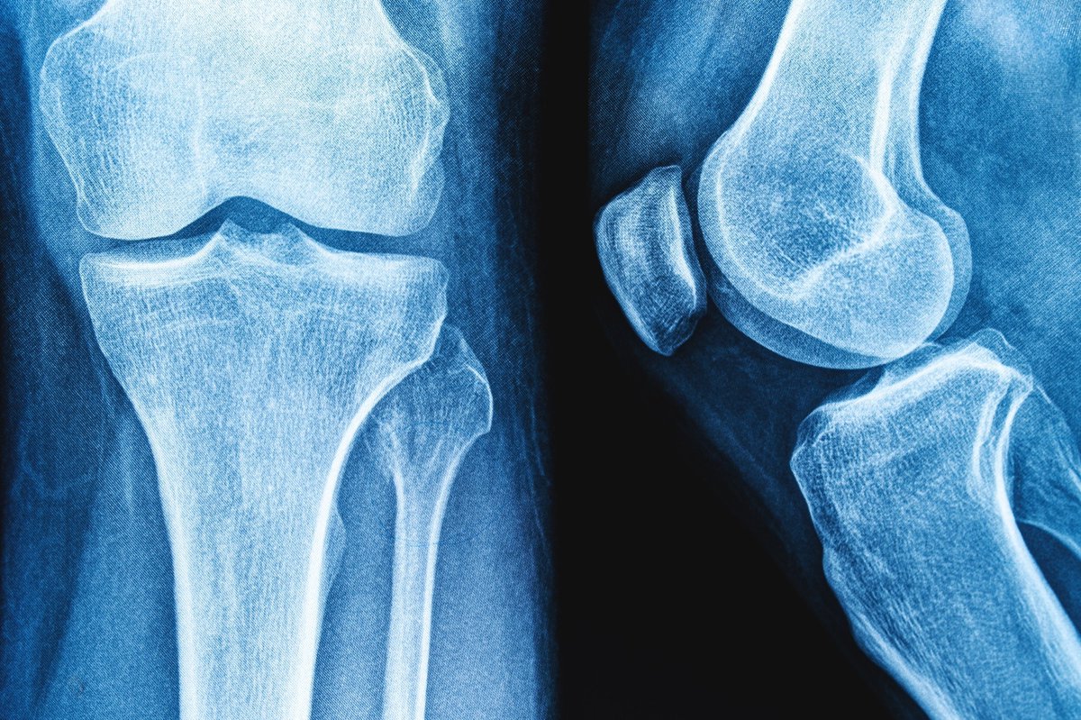 NewsMedical's tweet image. 🥛🍦 Can yogurt really strengthen your bones? A new review says the evidence falls short when it comes to fracture protection - even though yogurt is loaded with nutrients. Curious why? Read more: news-medical.net/news/20251019/… #BoneHealth #Nutrition #Yogurt @FrontNutrition