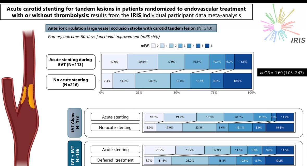 whitfieldlewis6's tweet image. This graph sums it up. In acute stroke with tandem lesions (ICA + intracranial occlusion), acute carotid stenting during EVT was associated with better 90-day outcomes than EVT without stenting.

Outcomes were similar with or without prior IV thrombolysis (IVT).

Caveat:…