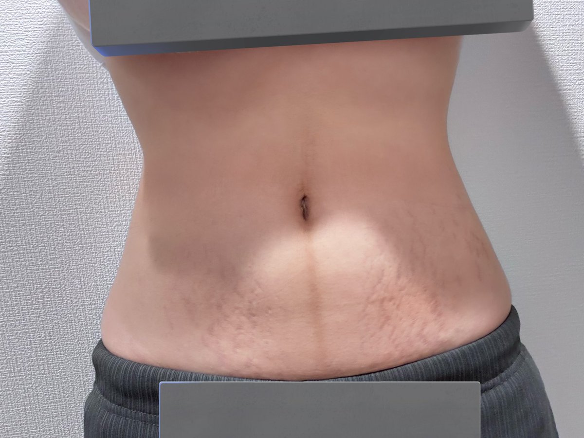 _YAMATOSAMA's tweet image. ほんの数ヶ月前まで体型これだったのまじなの、、？？？？？
このはみ出るようになった肉はどうしたらいいの？？？？？？？？？？あと3キロが落ちないんだけどどうしたらいいの？？？？？？？
Bioil塗りたくったけど子と共に頑張った線は消えなそう😭😱