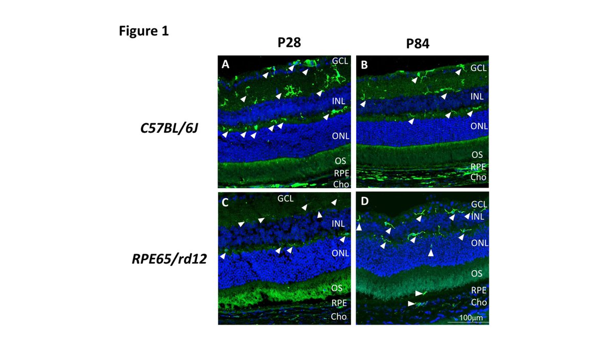 Graefes  rdcu.be/eKyjy 
Mononuclear phagocyte migration RPE65/rd12 is associated with diminished retinal function 
<a href="/ClinMedJournals/">Springer Medicine</a> <a href="/Ophthalmologen/">DOG-Augenheilkunde</a> <a href="/meyer_professor/">Carsten H. Meyer</a> <a href="/oliverzeitz/">Oliver Zeitz</a> <a href="/AndrzejGrzybow/">Andrzej Grzybowski</a> <a href="/EdmundTsuiMD/">Edmund Tsui, MD</a> @kopicAndrijana <a href="/JiaHorungMD/">Jia-Horung Hung</a> <a href="/KusuharaSentaro/">Sentaro Kusuhara</a> <a href="/SN_Ophthalmol/">Springer Nature Ophthalmology</a>