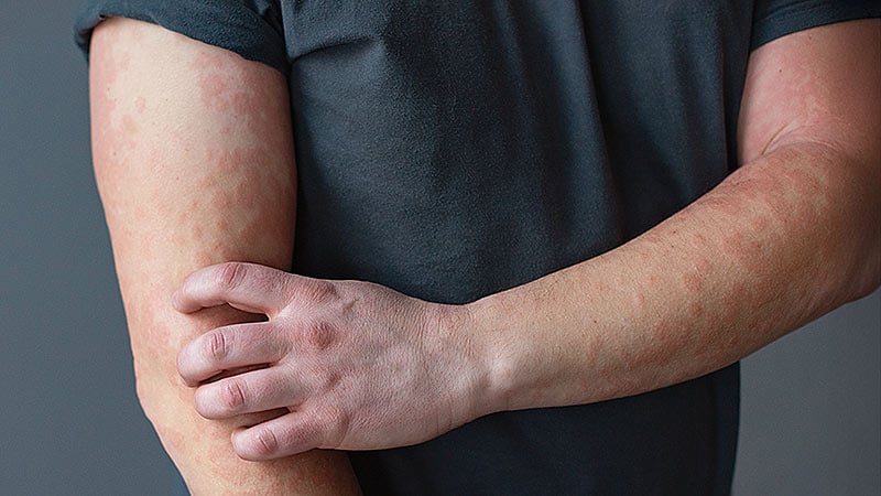 Lebrikizumab Safe and Effective in Atopic Dermatitis
ms.spr.ly/6011sfqyd