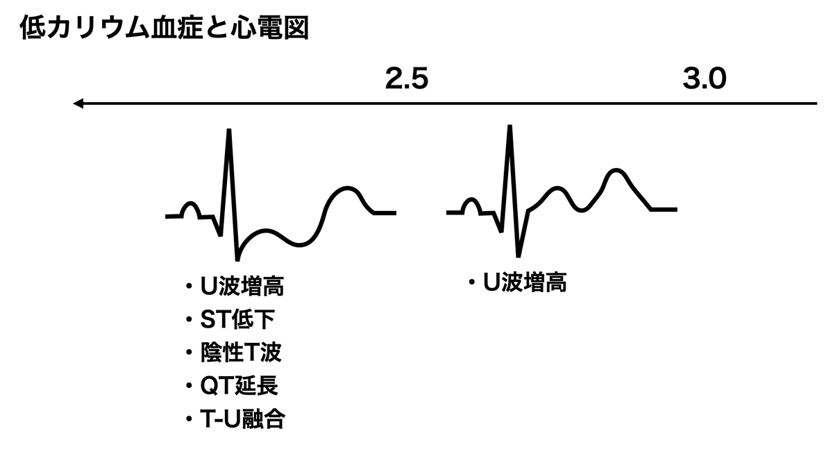 高/低カリウム血症と心電図変化
カリウムの異常が不整脈の原因となるのは常識ですが、数値と心電図変化にはだいたい相関があると言われています。
モニターでこいつらを見たら採血チェックしましょう。
