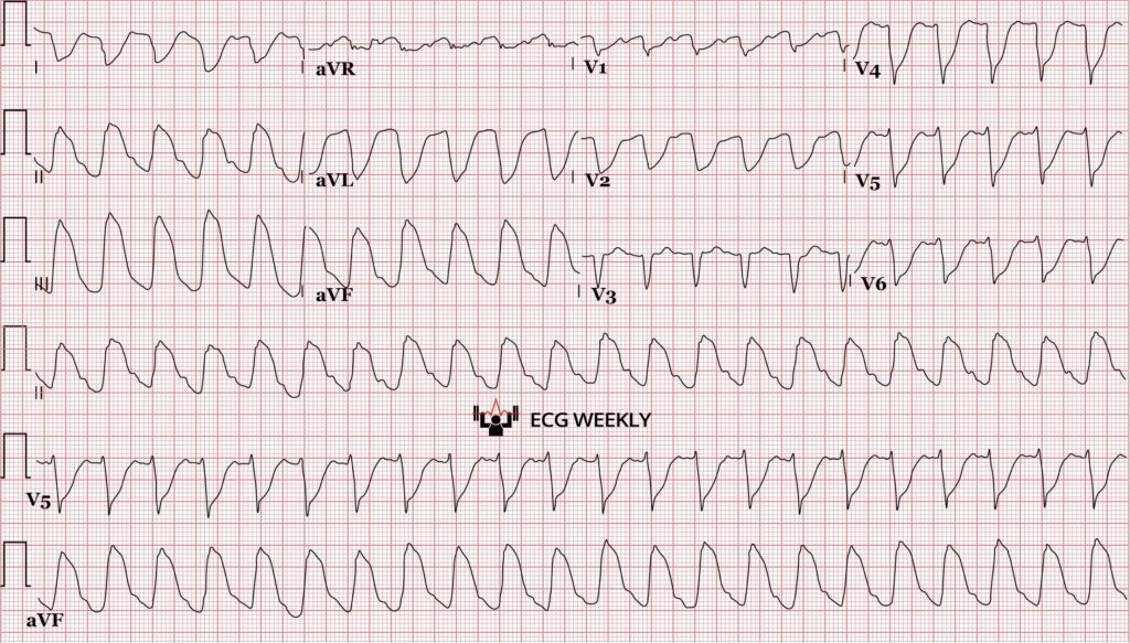 A 40-yo man presents with chest discomfort and shortness of breath. He’s ashen, diaphoretic, and hypotensive at 90/45. The ECG monitor shows a wide-complex regular tachycardia at 135 bpm concerning for ventricular tachycardia....ecgweekly.com/weekly-workout…