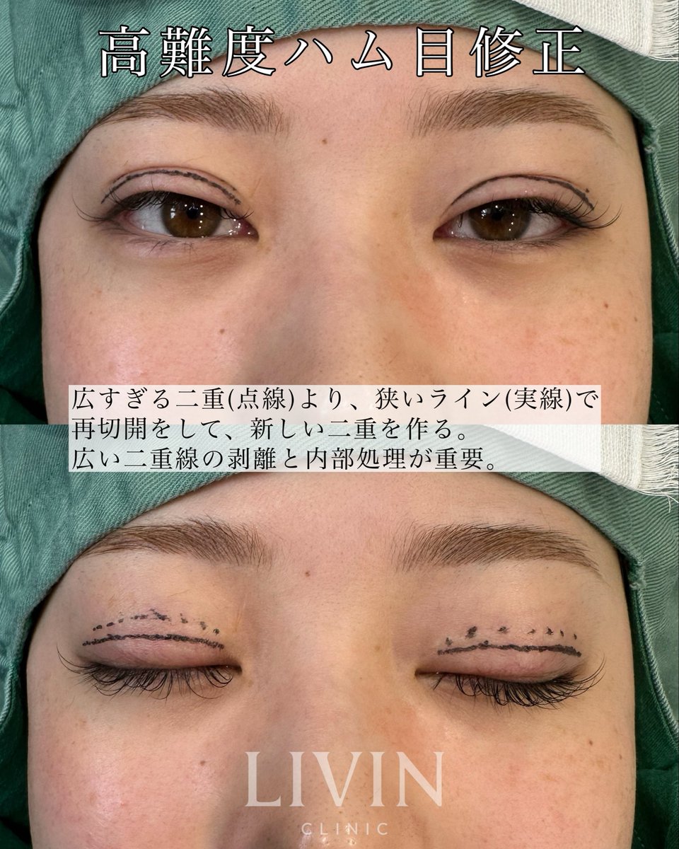 新行内芳明【自然で美しい目整形・鼻整形・ヒアルロン酸】 tweet media