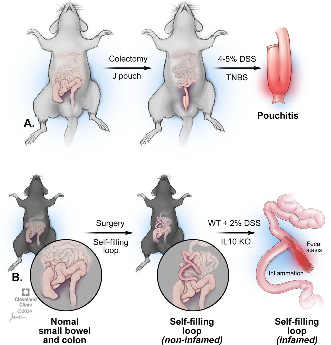 Gut_BMJ's tweet photo. #GUTImage from the #GUTRecentAdvancesInBasicScience paper by @manuelbragaMD et al entitled
"Cellular and molecular mechanisms in the pathogenesis of pouchitis: more than just the microbiota" via
https://t.co/rgB9br8osV
@IBD_FloMD #Pouchitis #IBD https://t.co/YVf1b6ex3V