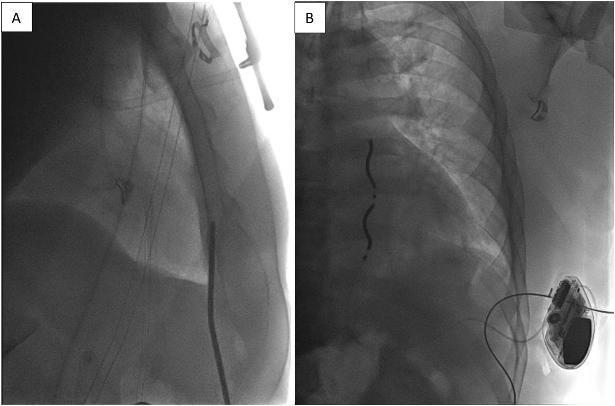 Hitting A New PR: Extravascular ICD Implant in a Professional Powerlifter 
<a href="/francisphanmd/">Francis Phan, MD</a> 
heartrhythmcasereports.com/article/S2214-…