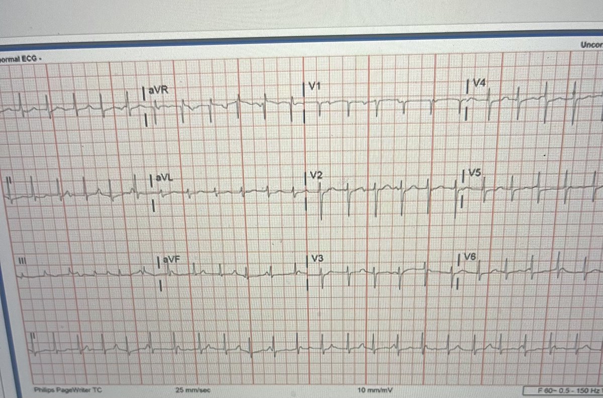 Crowdsourcing this ECG that a colleague sent me. 

I don't know much history other than there has been no heart surgery and no dig use 

RR intervals are stable 

(I have never seen such a thing.)
