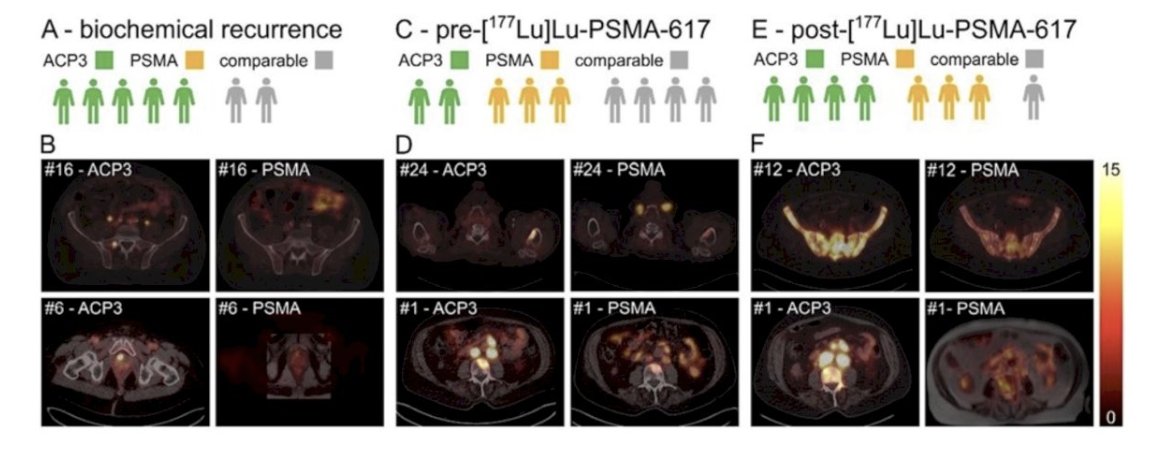 urotoday's tweet photo. Imaging and treatment of the prostatic acid phosphatase with 68Ga-OncoACP3-DOTA and 177Lu-OncoACP3-DOTA in #ProstateCancer patients. Presentation by @seifert_ke. #ESMO25 written coverage by @zklaassen_md > https://t.co/TdWHBxnzgN @myESMO https://t.co/jLNWtUZ7kB